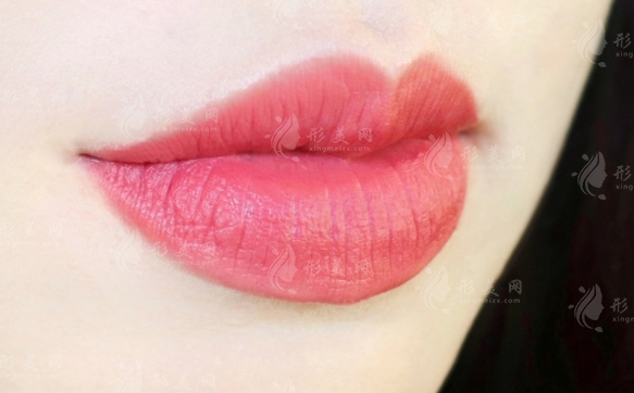 微笑唇可以保持幾年？影響因素全解析