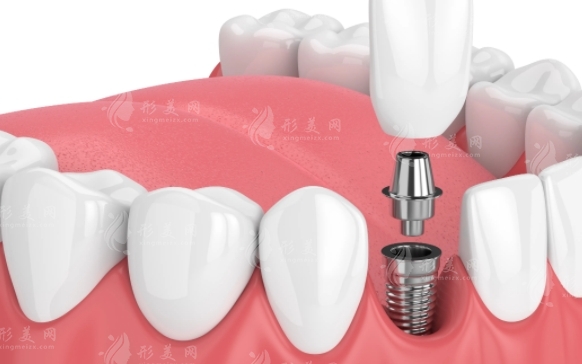 種植牙的步驟與術(shù)后恢復(fù)期注意事項(xiàng)