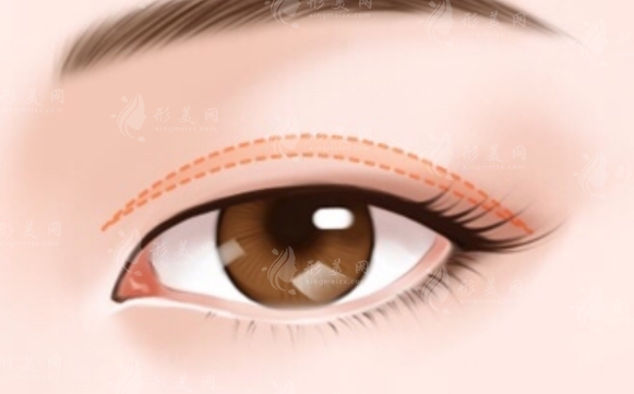 雙眼皮手術(shù)脂肪取少了會影響術(shù)后效果嗎？優(yōu)勢有哪些？