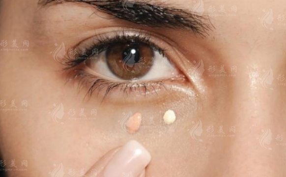 祛眼袋失敗了怎么辦？眼袋修復方法有哪些？