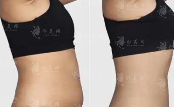 產(chǎn)后多久做吸脂減肥手術(shù)比較好？產(chǎn)后吸脂手術(shù)的禁忌癥一覽