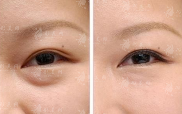 眼袋修復：并發(fā)癥與修復方法解析