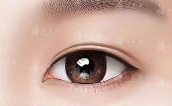 雙眼皮術(shù)：縫、割或微創(chuàng)——選擇前需深思熟慮