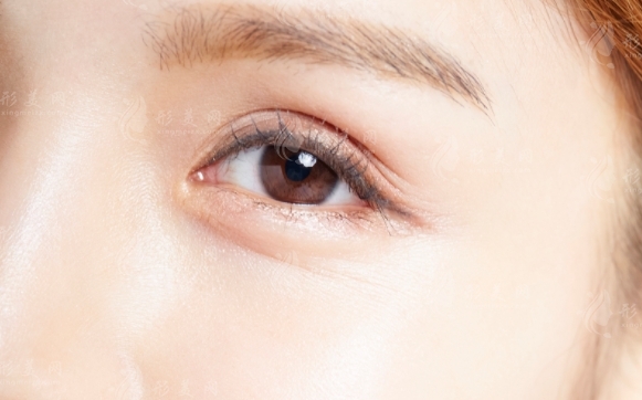 祛眼袋手術：效果維持與收費價格解析