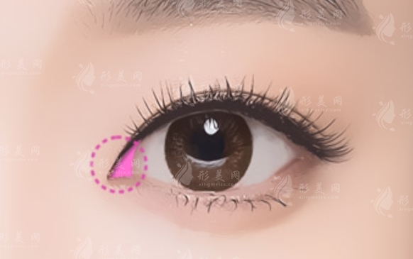 開(kāi)眼角術(shù)：解決小眼癥的有效方法及其術(shù)后恢復(fù)時(shí)間