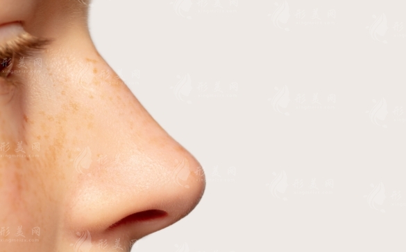 鼻翼內(nèi)切手術(shù)多少錢(qián)？與外切的區(qū)別有哪些？