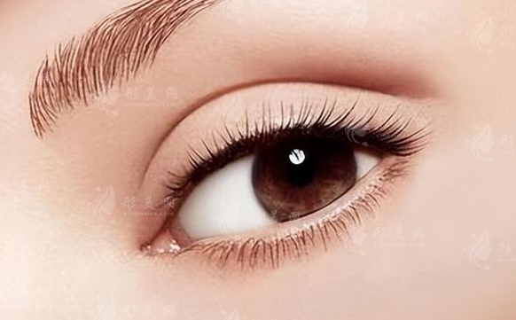 腫眼泡是否適合割雙眼皮及注意事項