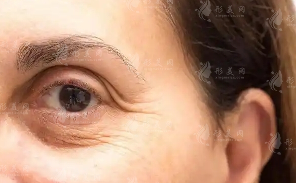 眼袋修復術的并發(fā)癥及處理辦法