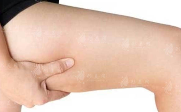大腿吸脂后出現(xiàn)肉條怎么辦？應(yīng)該怎么避免？