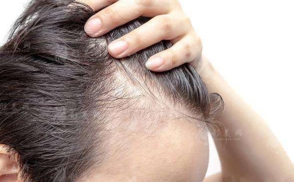 植發(fā)后脫落期：是否會(huì)影響效果？