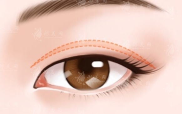 全切雙眼皮手術(shù)后兩側(cè)不一樣怎么辦？