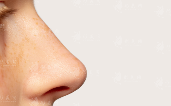 鼻尖縮小術(shù)：美麗重塑與快速恢復(fù)指南