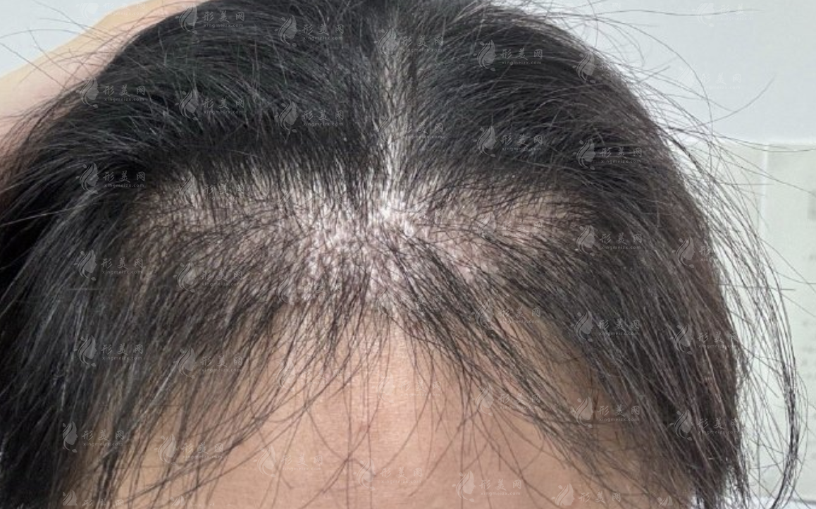 毛發(fā)移植：靜待時(shí)光，見證新生的奇跡