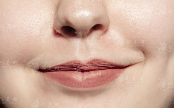 用玻尿酸填充法令紋后，紋反而更深了？如何改良法令紋？