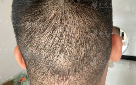 植發(fā)加密多少錢一個(gè)單位？會(huì)損傷原有頭發(fā)嗎？