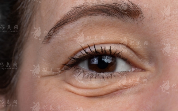 超聲波去眼袋：價格與效果維持時間解析