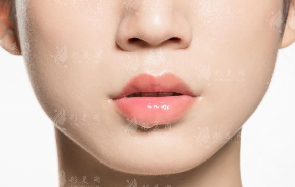 玻尿酸豐唇：大分子還是小分子？多久恢復(fù)自然？