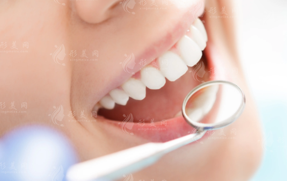 牙貼面時(shí)間久了牙齒會(huì)不會(huì)爛？這幾點(diǎn)一定得注意了