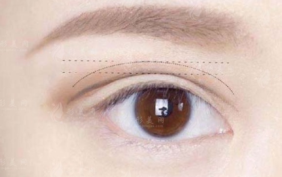 雙眼皮修復：方法、必要性及適用情況