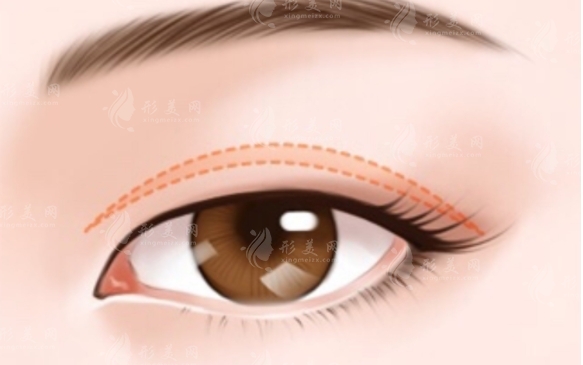 雙眼皮手術(shù)后熱敷會加重疤痕增生嗎？