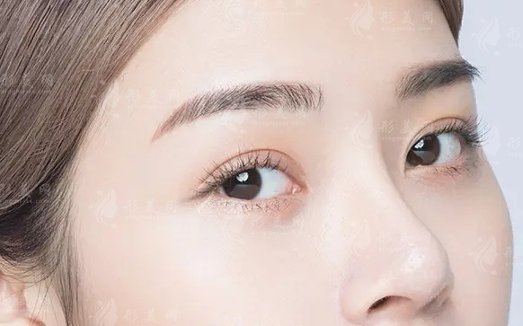 隆鼻假體取出手術(shù)：難易度解析與安心指南