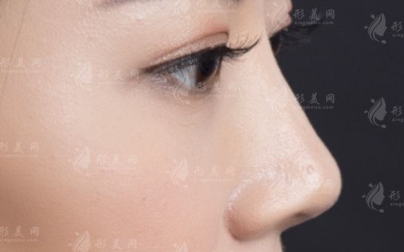 膨體隆鼻術(shù)易感染的原因：變美之路的挑戰(zhàn)