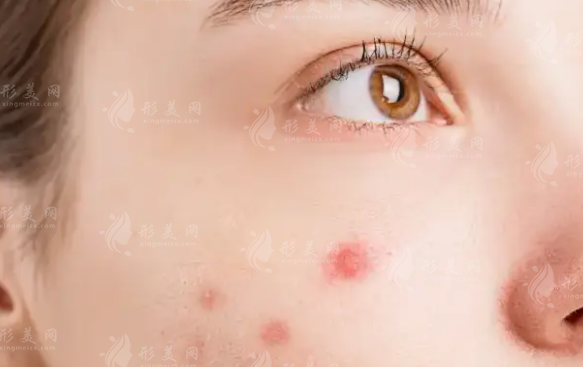 激光去痘痘要多少錢？影響價(jià)格的幾點(diǎn)因素