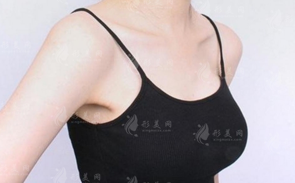 假體隆胸手術(shù)失敗修復(fù)難度高嗎？恢復(fù)時(shí)間長(zhǎng)不長(zhǎng)？