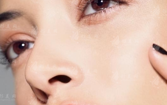 假體隆鼻效果不滿意：何時取出假體比較適宜？