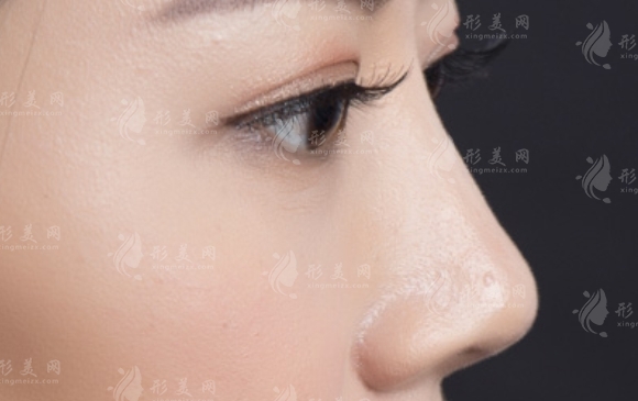 鼻子皮膚薄適合做硅膠假體隆鼻嗎？