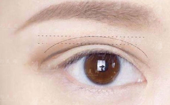 雙眼皮疤痕修復會反彈嗎？塑造魅力大眼睛的秘訣