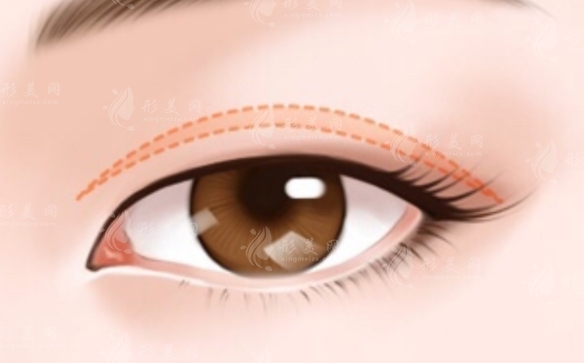 拉雙眼皮后出現(xiàn)肉條和出血：原因、預(yù)防與避免