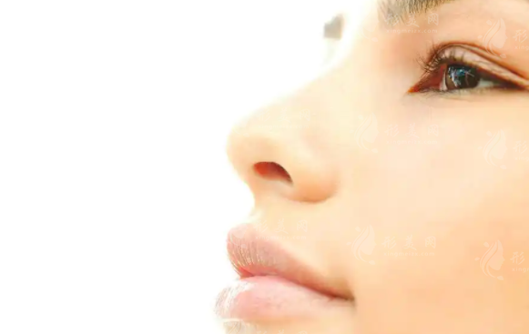 內(nèi)切鼻翼縮?。夯謴蜁r間與疤痕問題解析