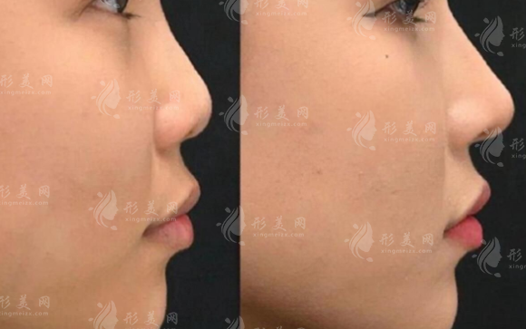 西安鼻整形醫(yī)生哪家好？2026熱門(mén)醫(yī)生+價(jià)格全解析