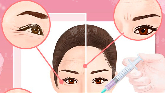 川字紋打玻尿酸還是除皺針？看完這篇不花冤枉錢