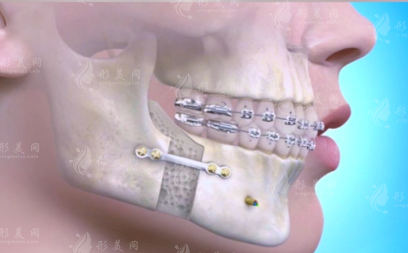 成都頦成型手術(shù)醫(yī)生推薦：這三位李姓醫(yī)生技術(shù)絕了!