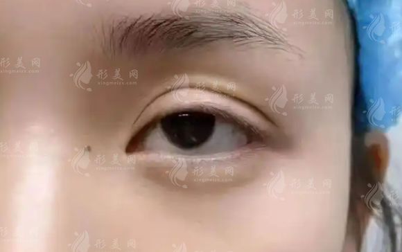 北京張冰潔眼修復口碑怎么樣?20年經驗+解剖復位技術解析