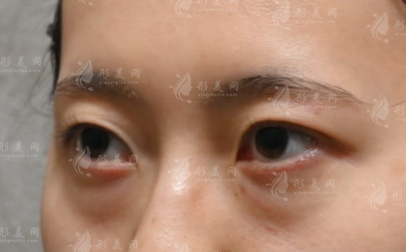 580元改善眼袋靠譜嗎?揭秘低價(jià)去眼袋的隱藏真相