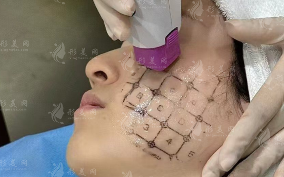 蘇州熱瑪吉價(jià)格表2026：第四代全臉600發(fā)7800元起值得做嗎?