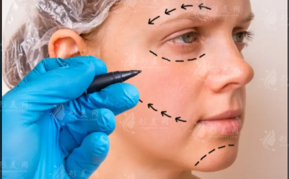 北京蒂凡妮筋膜提升靠譜嗎?王志堅醫(yī)生親診，微創(chuàng)抗衰新選擇!