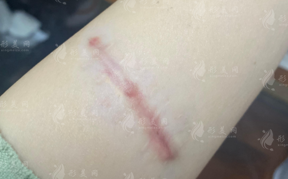 武漢祛疤哪個(gè)醫(yī)院好?2026新排名+價(jià)格表!