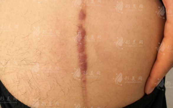 于艷菊治疤痕效果好嗎?專業(yè)解讀來了