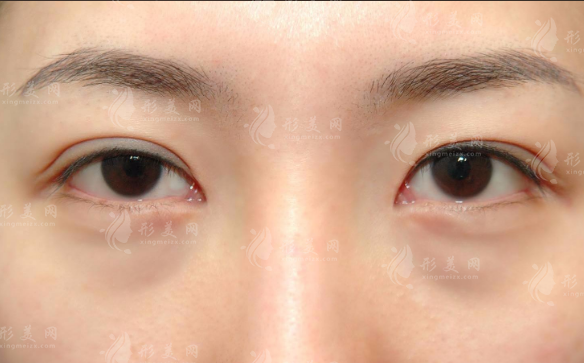 鄭州健麗醫(yī)美不開刀祛眼袋，微創(chuàng)無痕告別眼袋煩惱