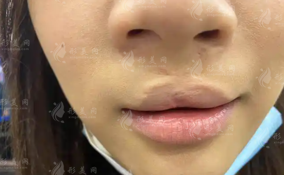 2026上海唇裂修復(fù)哪家好?伯思立、華美、海華三大名醫(yī)實力PK