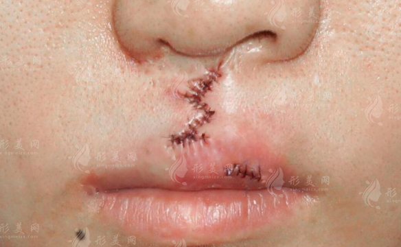 唇腭裂手術(shù)國(guó)家補(bǔ)貼怎么領(lǐng)？2026新政策+申請(qǐng)攻略+報(bào)銷(xiāo)比例一覽