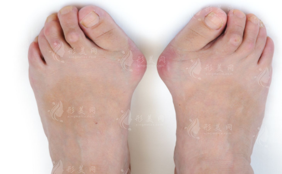 大腳骨微創(chuàng)手術(shù)哪家醫(yī)院好？全國(guó)拇外翻正規(guī)醫(yī)院排名前十公布