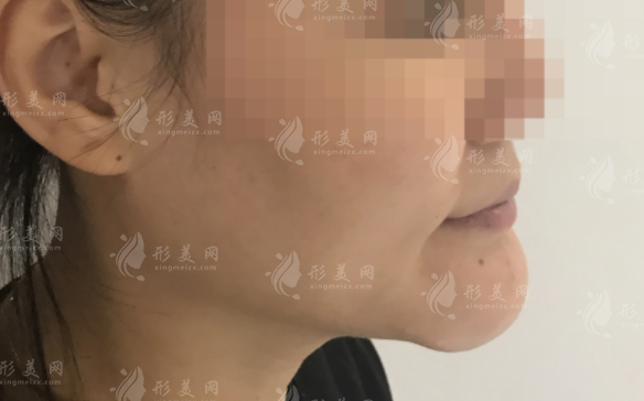 廣州漫一凡醫(yī)生取生長因子靠譜嗎？4K內(nèi)窺鏡精準(zhǔn)取出技術(shù)解析