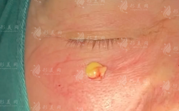 生長因子取出多少錢?2026國內(nèi)5強(qiáng)醫(yī)院排名:技術(shù)醫(yī)生費用全攻略