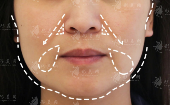 上海張曉建拉皮手術(shù)多少錢(qián)?技術(shù)優(yōu)勢(shì)+價(jià)格+適合人群全攻略