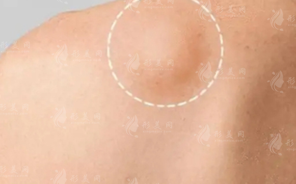 上海脂肪結(jié)節(jié)修復(fù)哪家好?謝衛(wèi)國(guó)盧九寧蹇洪技術(shù)口碑全解析